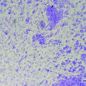 Mikroskopisk billede af Forberedelsesslide: Tre type B viser blå og lilla farvede celleklynger og fibrøse strukturer.