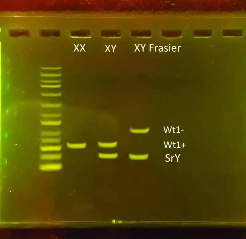 En DNA-elektroforese fra Genetisk testkit til Frasier syndrom viser bånd for XX, XY og XY Frasier samt markører Wt1-, Wt1+ og SrY.