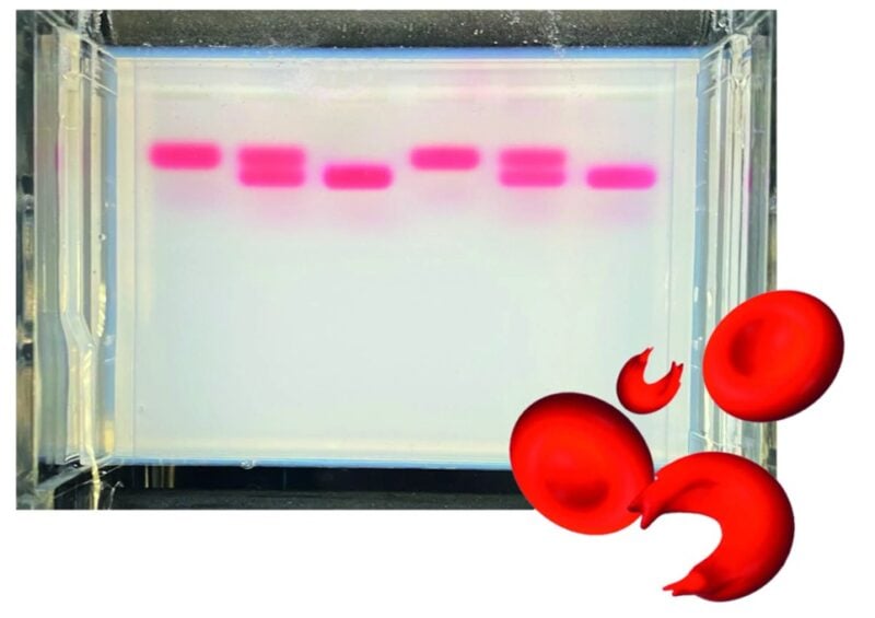 Seglcelleanæmi-kit med analog hæmoglobiner viser pinkfarvede gelbånd og tre røde blodlegemer, herunder en seglformet celle.