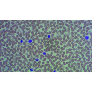 Mikroskopiske præparater: Lymfesystemet - Menneskeblod: sepsis, udstrygning