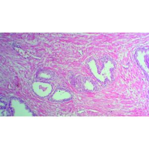 Mikroskopiske præparater: Histologi af hvirveldyr - Prostatakræft
